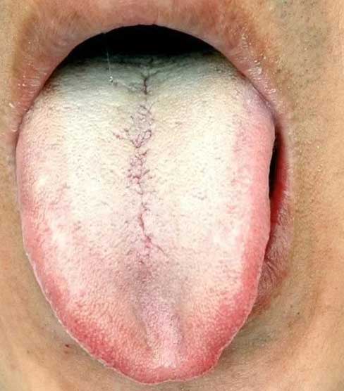 《中医舌诊》26个临床高清舌诊图(图12)