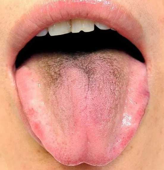 《中医舌诊》26个临床高清舌诊图(图17)