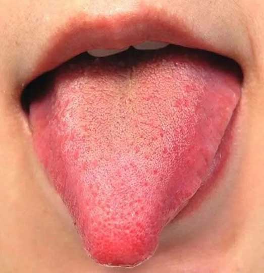 《中医舌诊》26个临床高清舌诊图(图19)