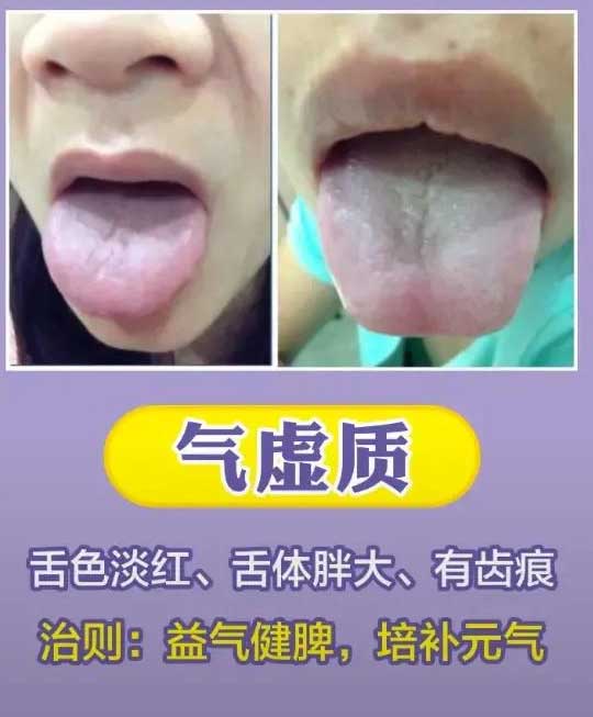 《中医舌诊》最常见九大体质舌诊图(图4)