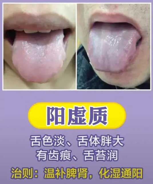 《中医舌诊》最常见九大体质舌诊图(图7)