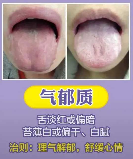《中医舌诊》最常见九大体质舌诊图(图6)