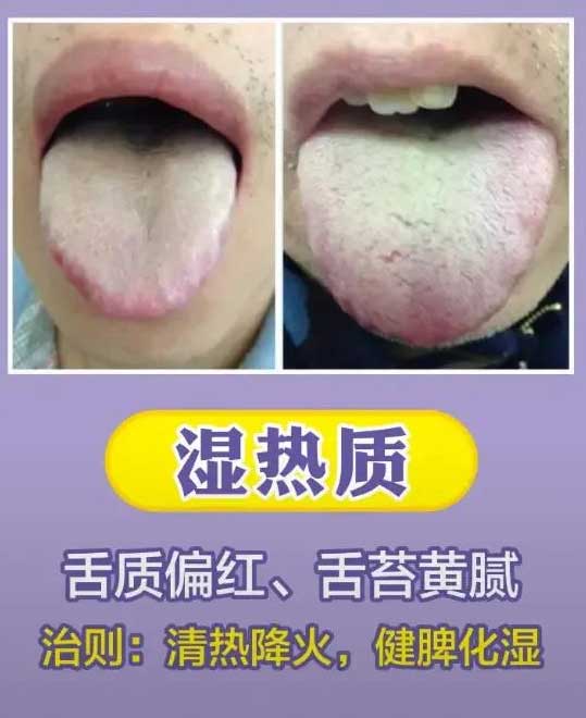 《中医舌诊》最常见九大体质舌诊图(图8)