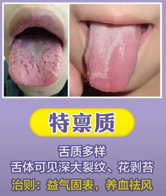 《中医舌诊》最常见九大体质舌诊图(图9)