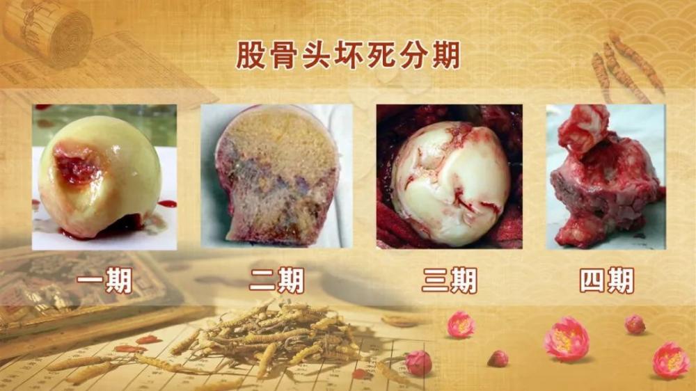 刘渡舟治疗股骨头坏死医案2则(图1)