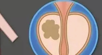 前列腺增大（癃闭）经方秘方