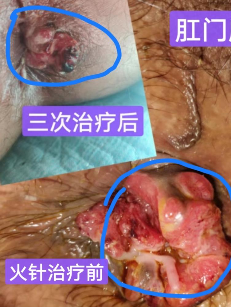 火针治疗淋巴癌（淋巴瘤）、皮肤癌、鳞状细胞癌(图2)